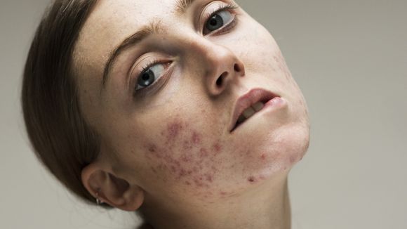 Acné, hyperpigmentation : cette photographe magnifie la peau et ses imperfections