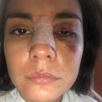 Les blessures de l'actrice Eileen Moreno, symboles des violences conjugales en Colombie