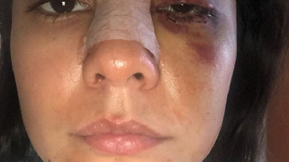 Les blessures de l'actrice Eileen Moreno, symboles des violences conjugales en Colombie
