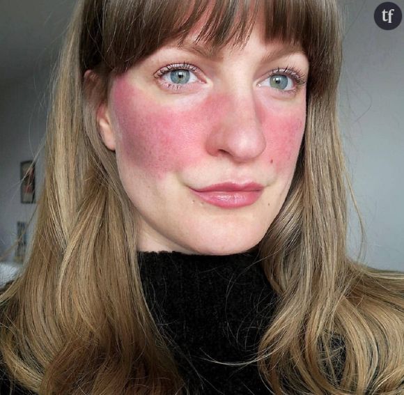 Elles posent sans filtre ni maquillage pour sensibiliser sur la rosacée