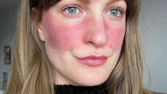 Elles posent sans filtre ni maquillage pour sensibiliser à la rosacée