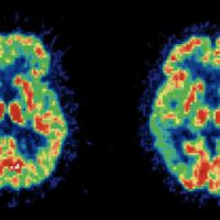 Alzheimer : la vitamine D et les oméga 3, nouvelles pistes de traitement ?