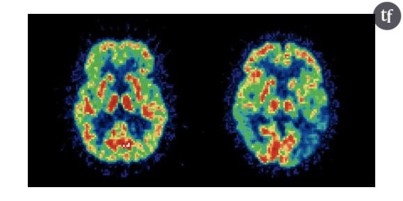 Alzheimer : la vitamine D et les oméga 3, nouvelles pistes de traitement ?