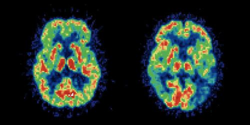 Alzheimer : la vitamine D et les oméga 3, nouvelles pistes de traitement ?