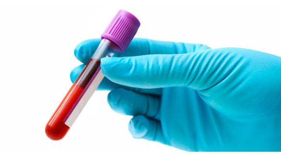 Cancer du poumon : une prise de sang pour le détecter et mieux le soigner ?