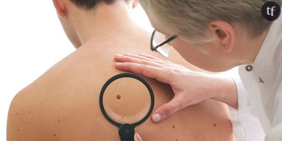 Cancer de la peau : comment surveiller ses grains de beauté ?