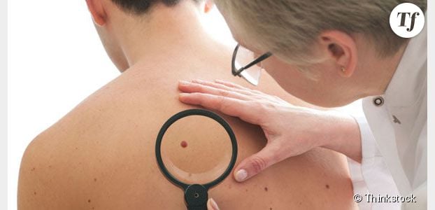 Cancer de la peau : comment surveiller ses grains de beauté ? 