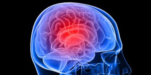 AVC : réduire le risque en sept actions