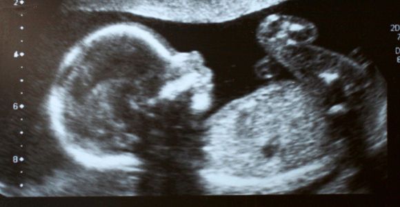Autisme : la pollution mise en cause