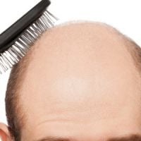 Calvitie : un traitement miracle pour faire repousser les cheveux enfin trouvé ?