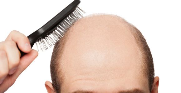 Calvitie : un traitement miracle pour faire repousser les cheveux enfin trouvé ?