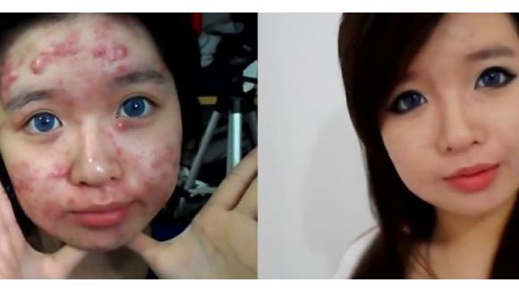 Cacher ses boutons : les conseils d'une ado souffrant d'une forme grave d'acné - vidéo