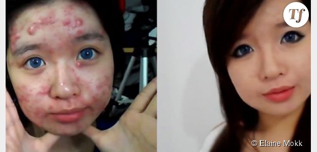 Cacher ses boutons : les conseils d'une ado souffrant d'une forme grave d'acné - vidéo