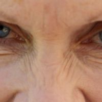 Santé des Femmes : rides et fractures osseuses seraient liées