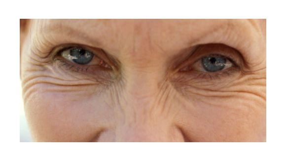 Santé des Femmes : rides et fractures osseuses seraient liées