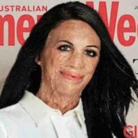 Un magazine féminin australien ose mettre une grande brûlée en couverture 