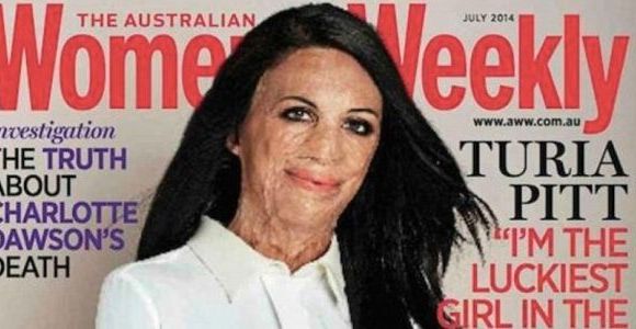 Un magazine féminin australien ose mettre une grande brûlée en couverture 
