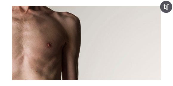 Un gène responsable de l'extrême maigreur