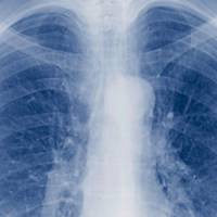 Alerte à la tuberculose à Clichy-sous-Bois