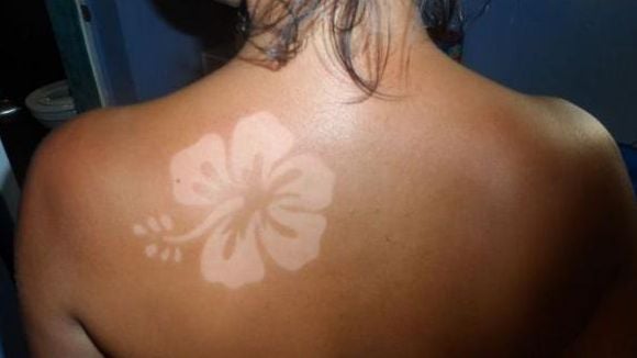 #SunBurnArt : le tatouage idiot à base de coup de soleil