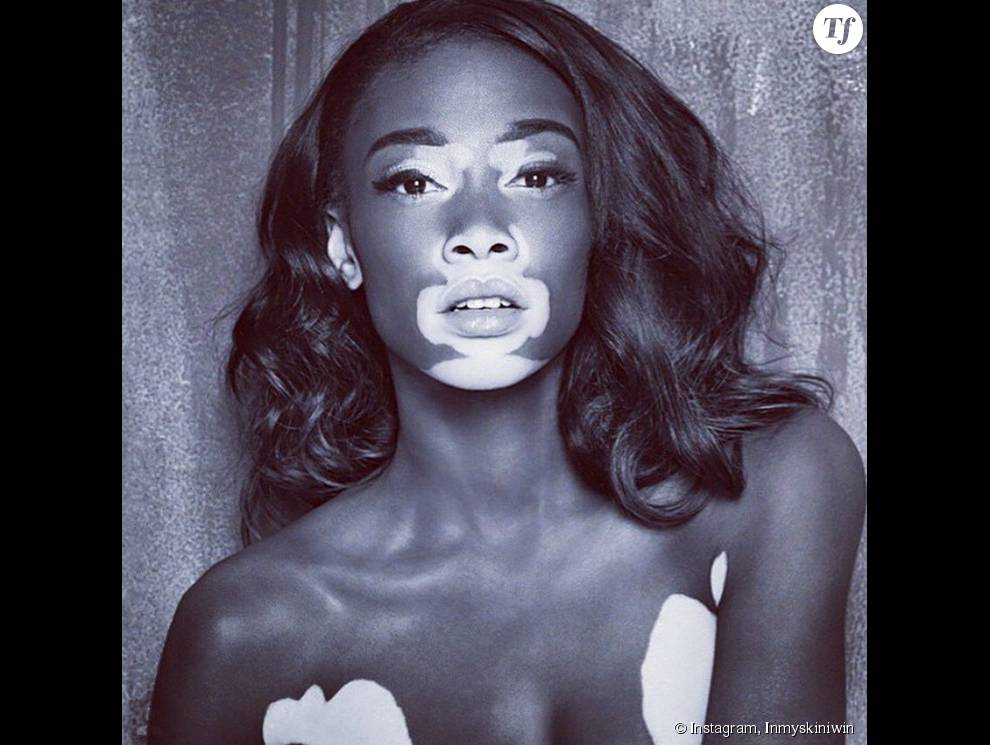 Le mannequin Winnie Harlow est atteinte de vitiligo, ce qui ne l&#039;empêche pas d&#039;être sublime.