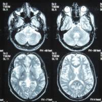 Une journée pour reconnaître l'AVC