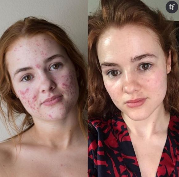 My Face Story : sur Instagram, le récit de son combat contre l'acné devient viral