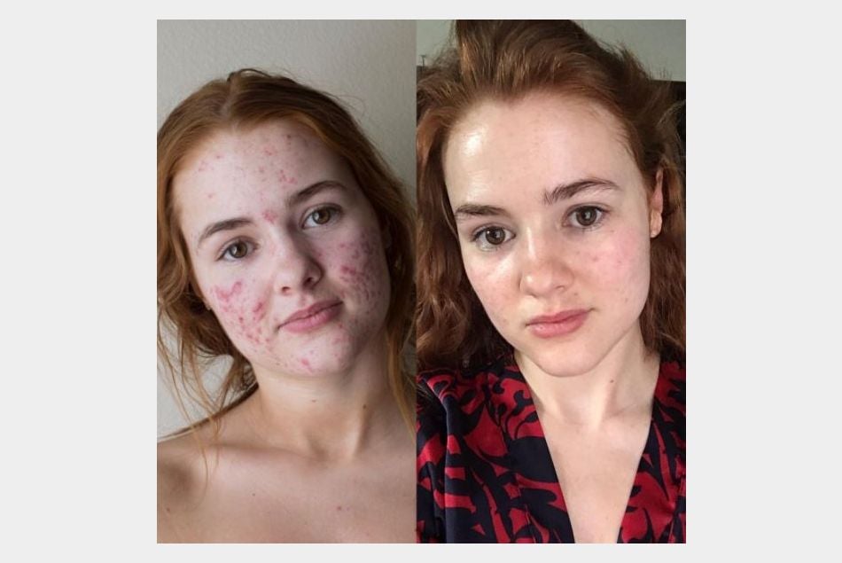 My Face Story : sur Instagram, le récit de son combat contre l'acné devient viral