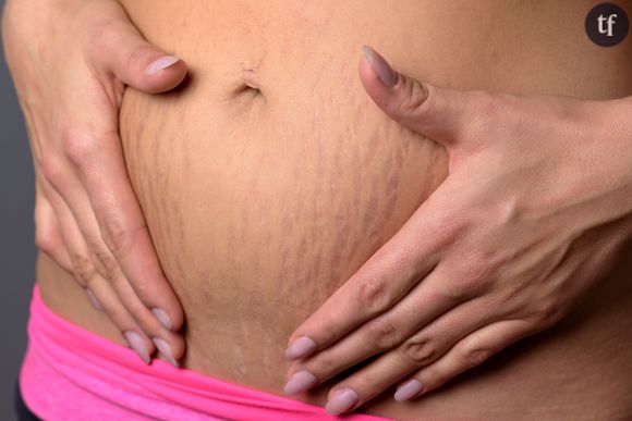 Une femme tient son ventre et entoure ses vergetures.