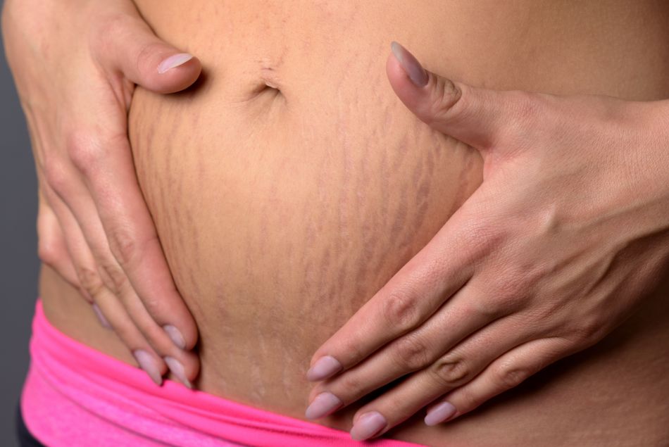 Une femme tient son ventre et entoure ses vergetures.