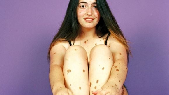 Ils sont "différents", ce photographe magnifie leurs imperfections