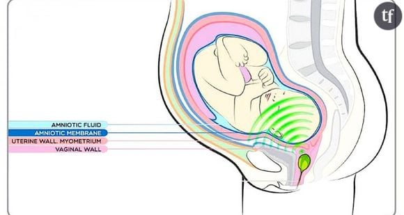 Babypod, les enceintes vaginales pour foetus