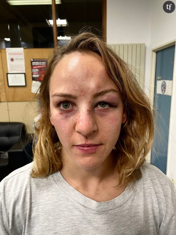 Le monde du judo sous le choc de la photo du visage tuméfié de Margaux Pinot [Twitter - Margaux Pinot]