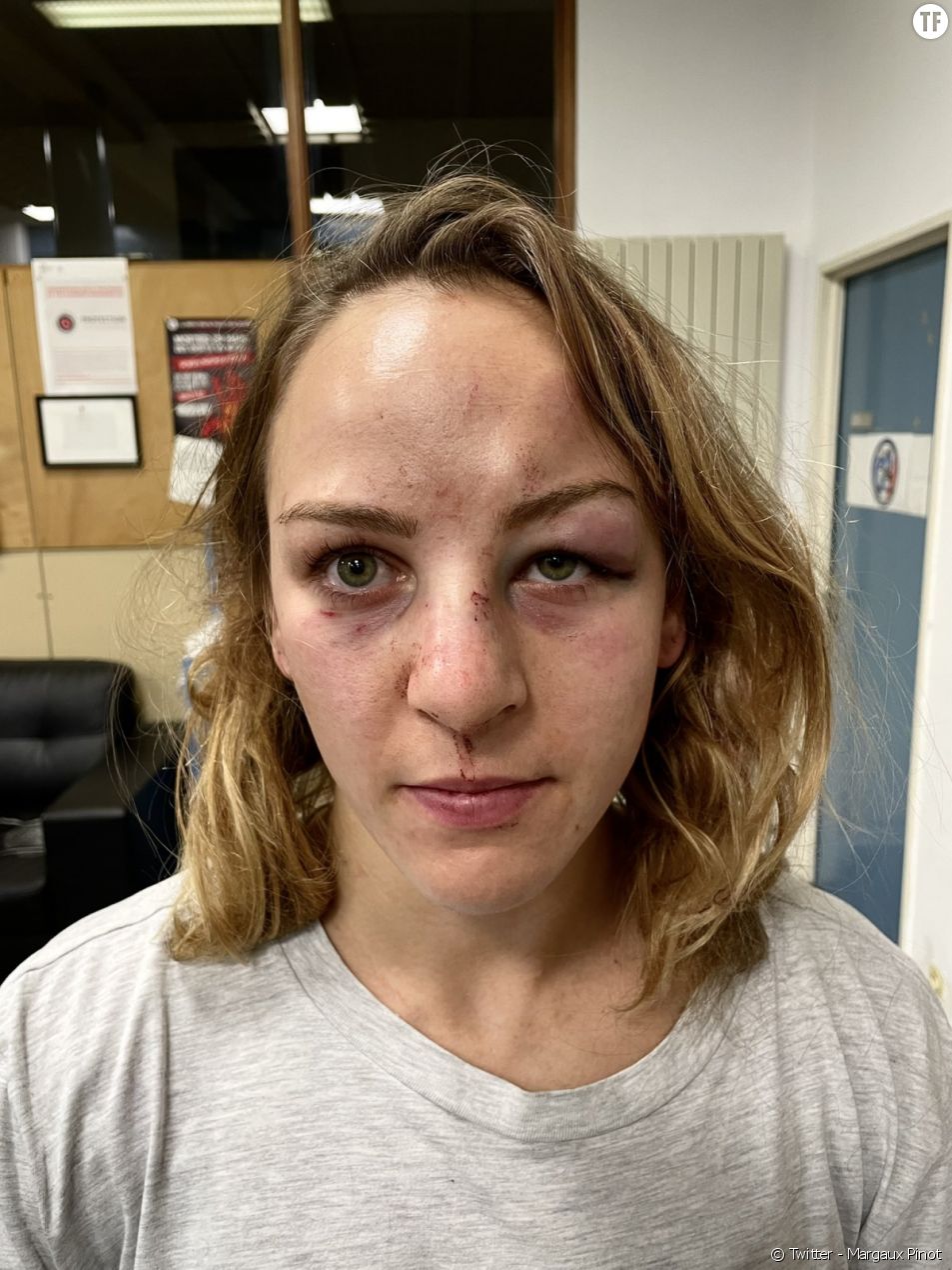 Le monde du judo sous le choc de la photo du visage tuméfié de Margaux Pinot [Twitter - Margaux Pinot]