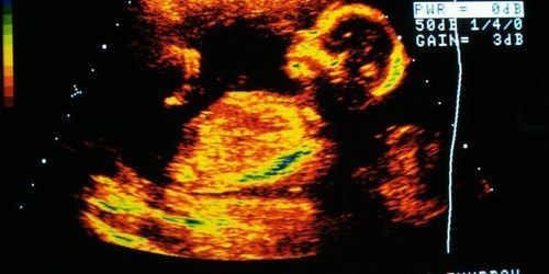 Canada : garder le sexe du bébé secret pour éviter l’avortement ?