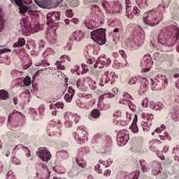 Cancer pédiatrique : la leucémie