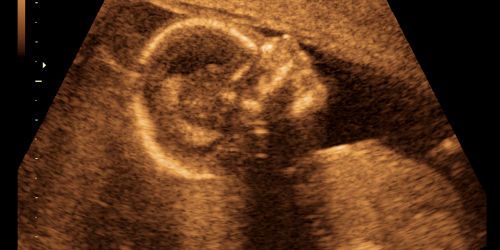 Dépistage prénatal : la quête du bébé parfait ?