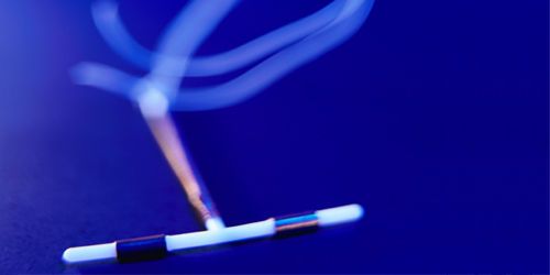 Contraception : le stérilet et l'implant plus efficaces que la pilule