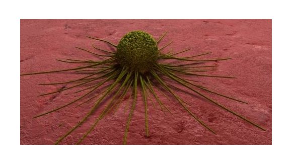 Cancer : augmentation des cas de 75% d'ici 2030 