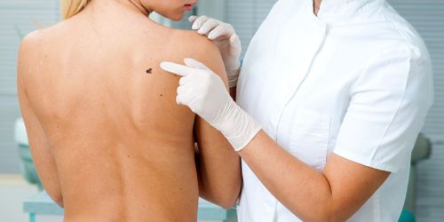 Cancer de la peau : les traitements progressent