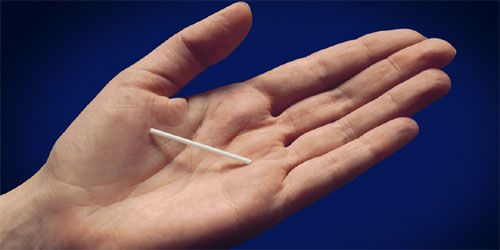 Contraception : des britanniques enceintes malgré leur implant contraceptif