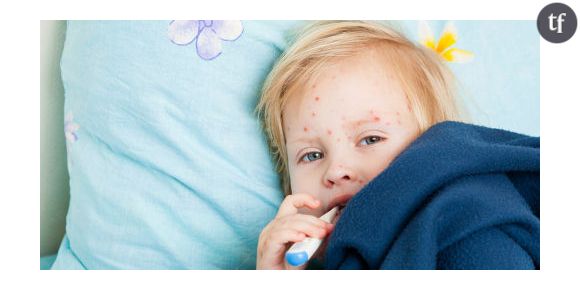 Varicelle : l'épidémie ralentit