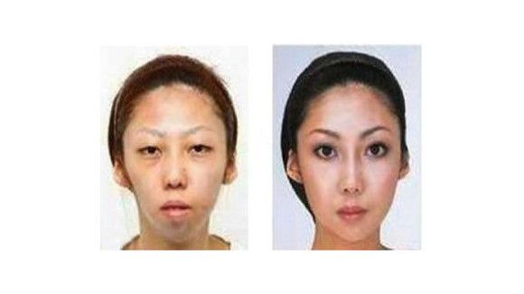 Chirurgie esthétique : une femme attaquée par son mari pour physique trompeur