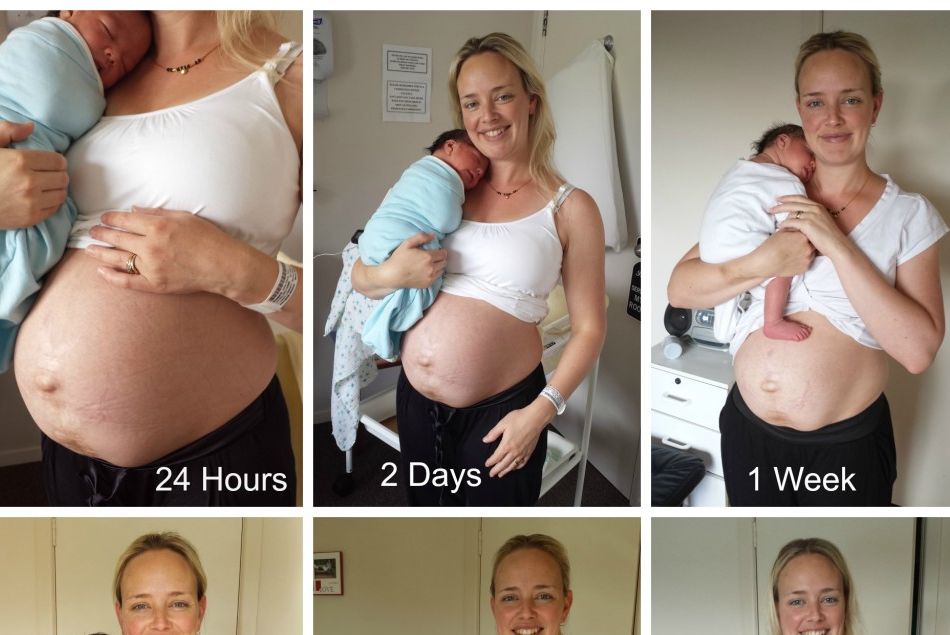 Elle partage les photos de son ventre post-grossesse pour rassurer les autres femmes