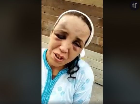 Une femme marocaine battue dévoile ses blessures. Capture d'écran Facebook.