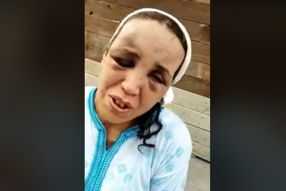Une femme marocaine battue dévoile ses blessures. Capture d'écran Facebook.