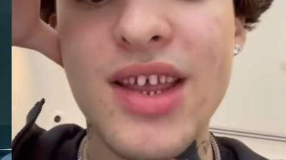 Ce dentiste alerte contre la tendance des "dents limées" sur TikTok