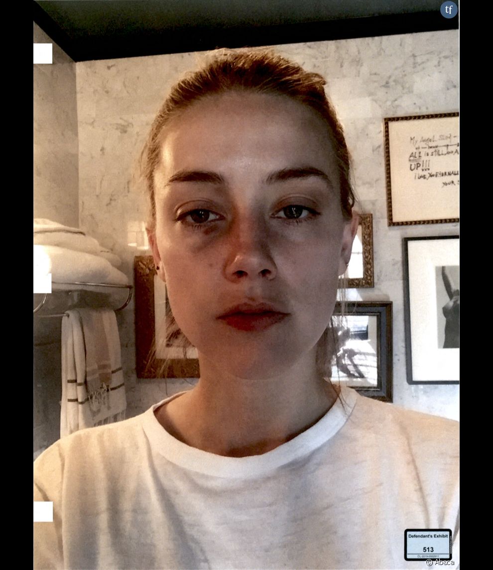  Le visage tuméfié d&#039;Amber Heard, photo du procès de Fairfax diffusée le 5 mai 2022 