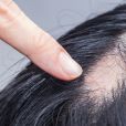        Cette accélération de la chute de cheveux ou des poils provoque bien souvent une           calvitie          , qui peut être source de complexes pour ceux qui en sont atteints       