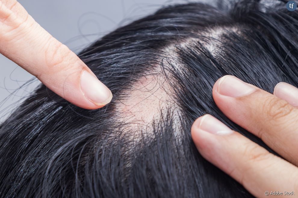        Cette accélération de la chute de cheveux ou des poils provoque bien souvent une           calvitie          , qui peut être source de complexes pour ceux qui en sont atteints       